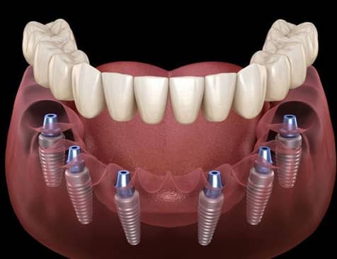 Slider image (7) DG Dental - Dr. Diana Gastelum